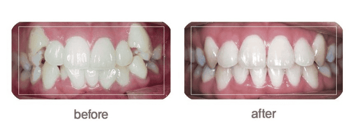 치아교정 비포 에프터
