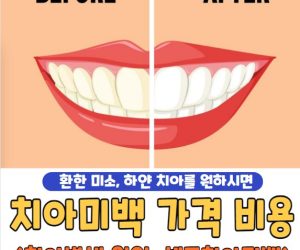 치과 치아미백 가격 비용 및 부작용, 셀프치아미백 차이 | 치아변색 원인