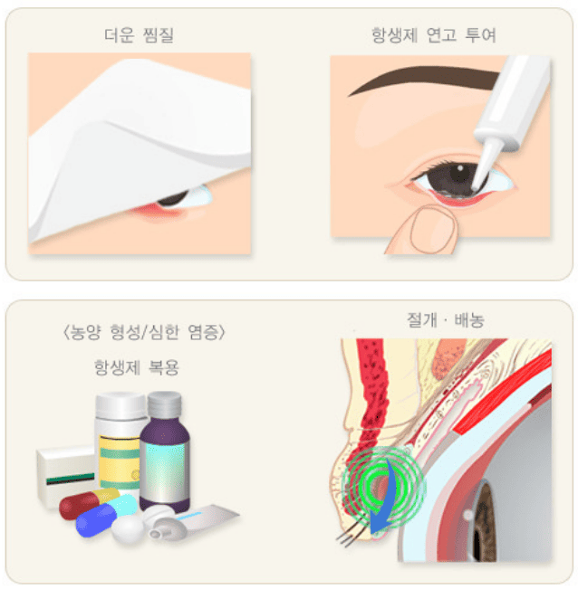 눈다래끼 치료