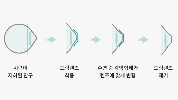 드림렌즈