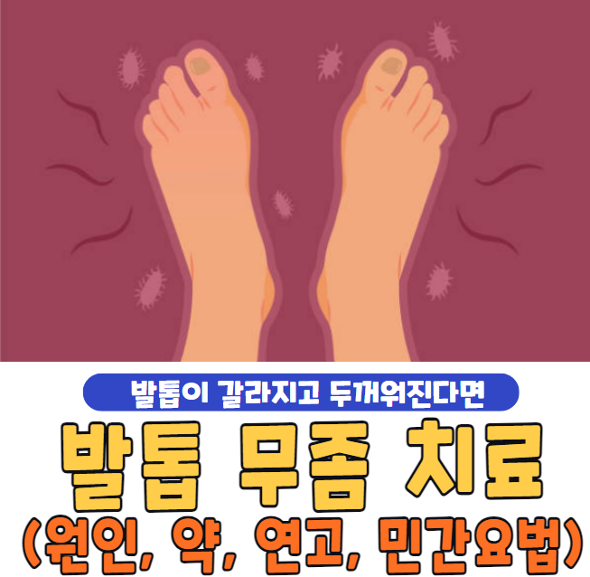 발톱 무좀 치료