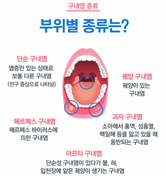 구내염 종류