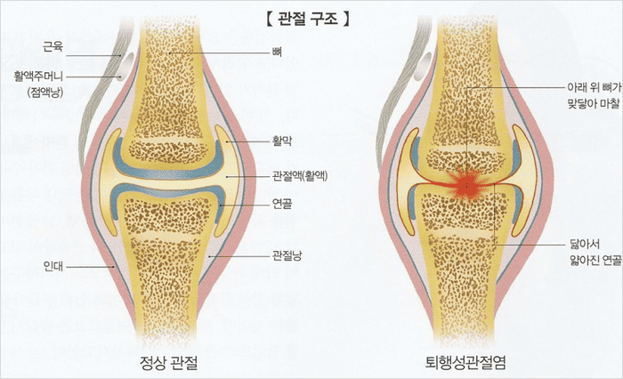 골관절염