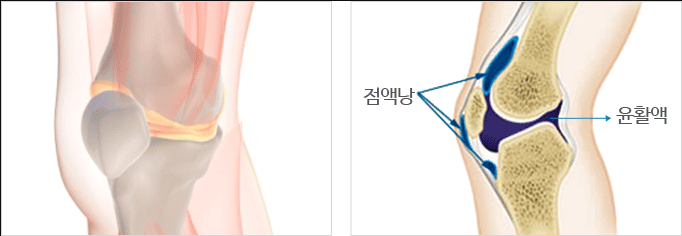 점액낭염
