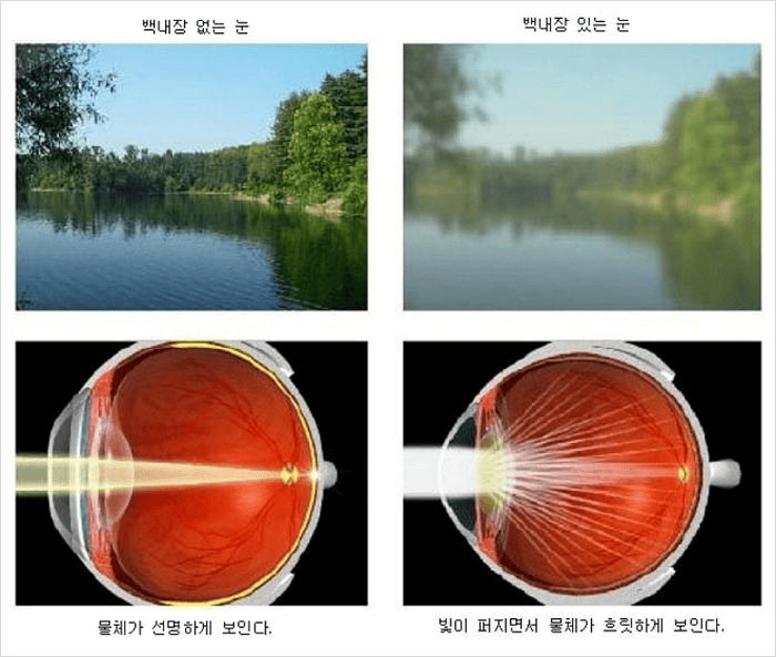 백내장 초기증상
