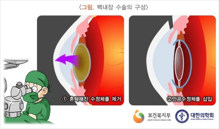 백내장 수술 방법