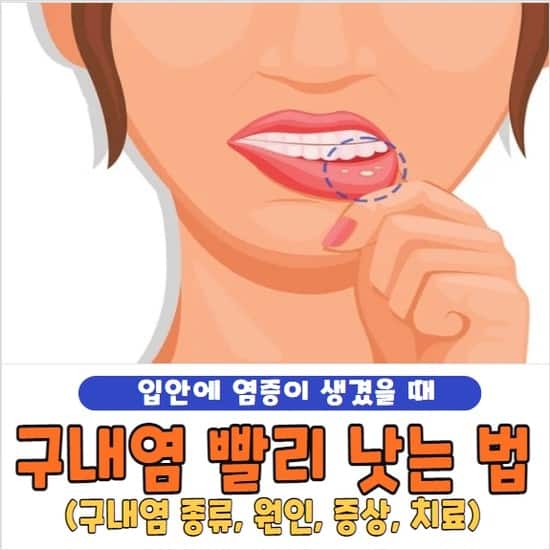 구내염 빨리 낫는법