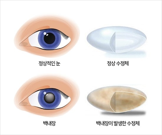 65세 이상 백내장 수술 비용