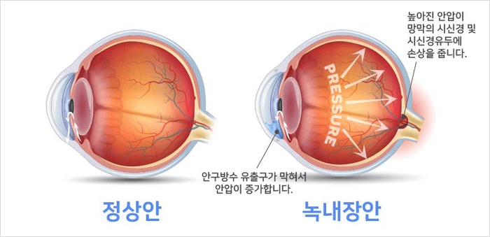 녹내장 원인