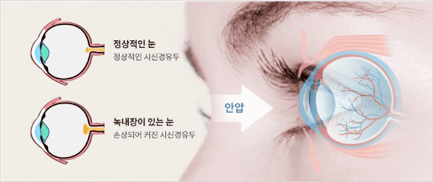녹내장