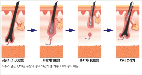 정수리 탈모