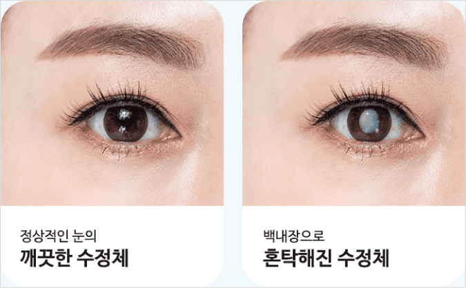 백내장이란