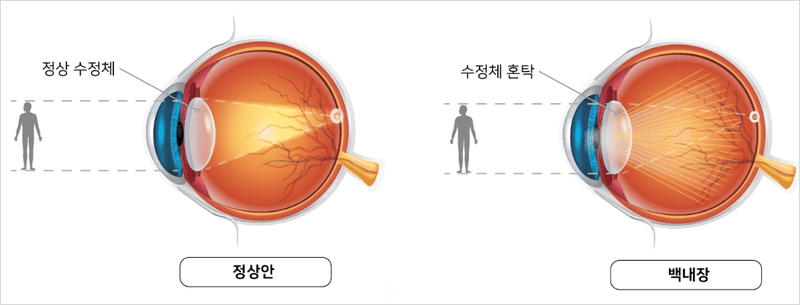 백내장 증상