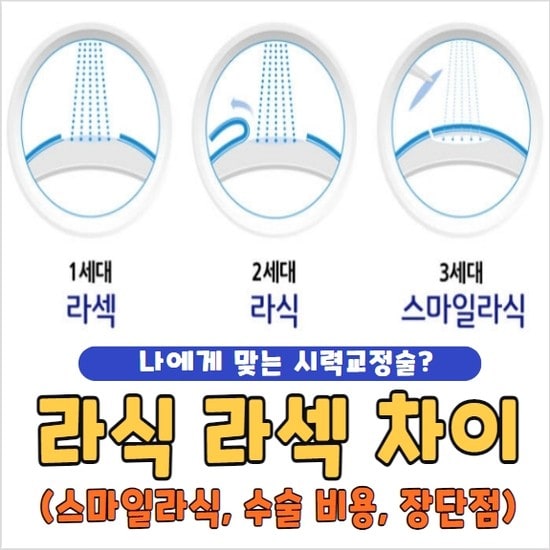 라식 라섹 차이