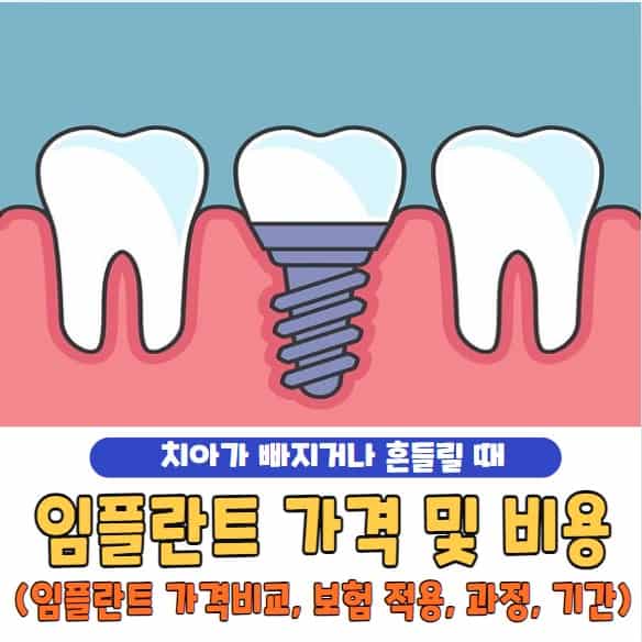 임플란트 가격