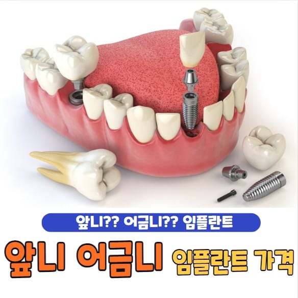 앞니 임플란트 가격
