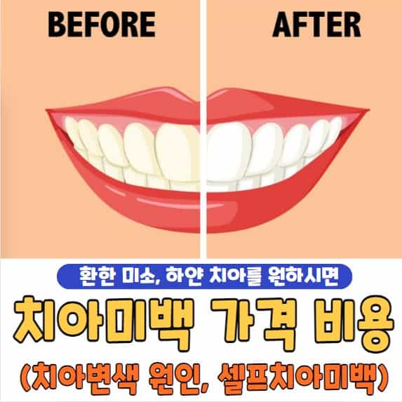 치과 치아미백 가격