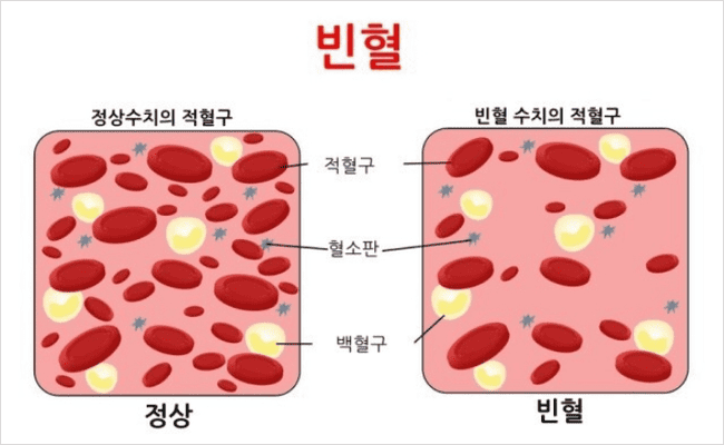 빈혈 검사
