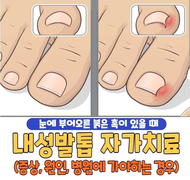 내성발톱 자가치료