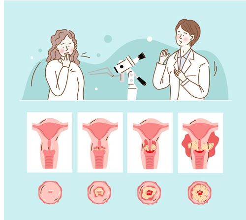자궁경부암 증상