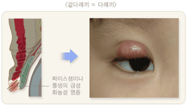 겉다래끼