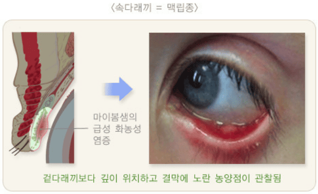 속다래끼