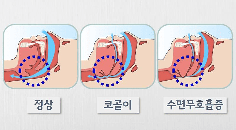 코골이 치료법