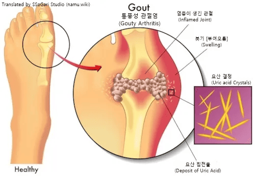 통풍 원인