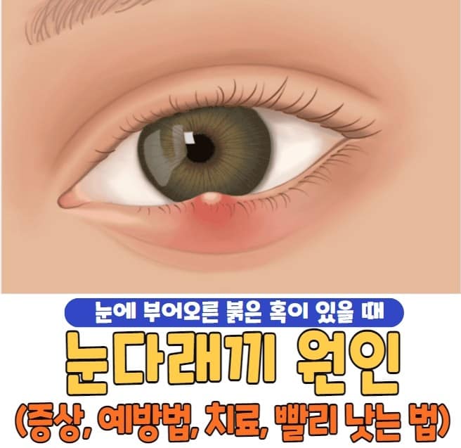 눈다래끼 원인
