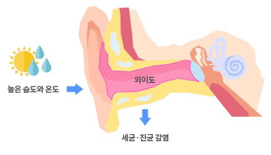 외이도염