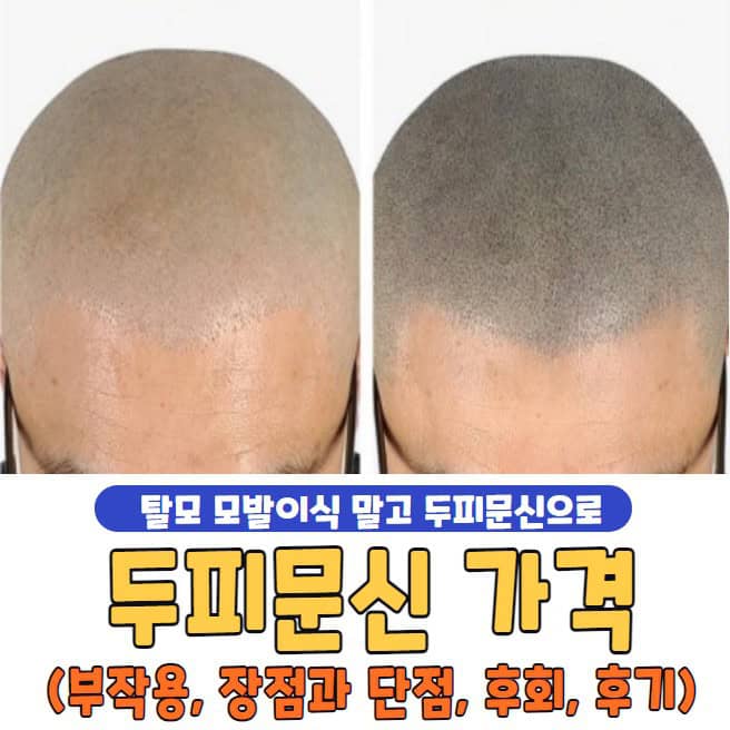 두피문신 가격