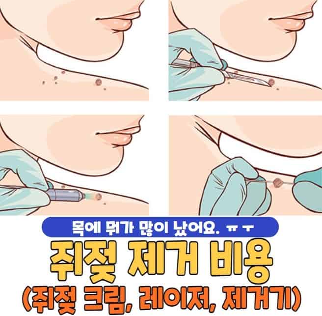 쥐젖 제거 비용