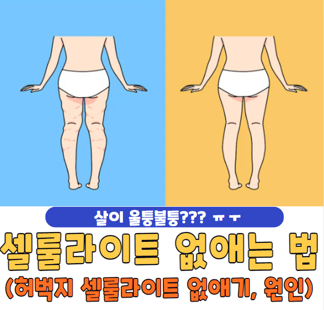 셀룰라이트 없애는 법
