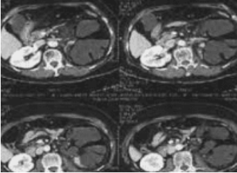 Abdomen CT 검사