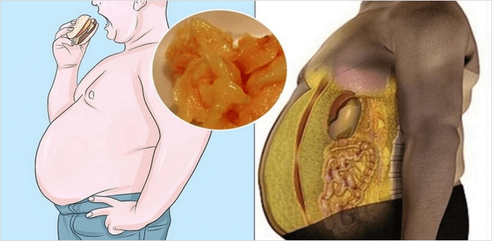 복부에 쌓인 지방층 설명