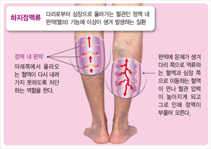 다리 정맥이 늘어나 튀어나온 하지정맥류