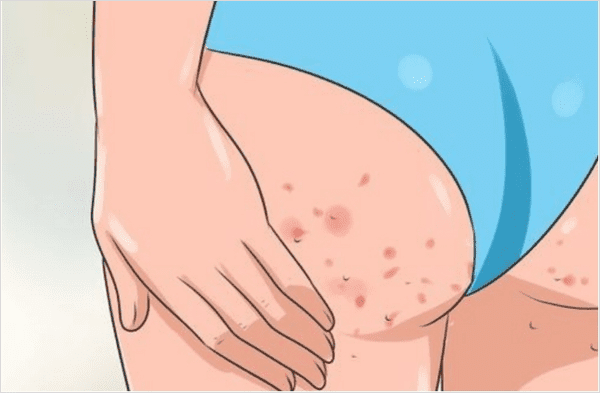 마찰과 면역력 저하 등 엉덩이 종기의 원인