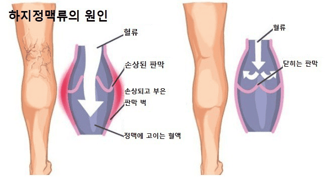 판막 손상으로 혈액이 역류하는 하지정맥류 원인