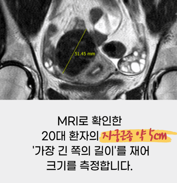 초음파로 측정하는 자궁근종 크기