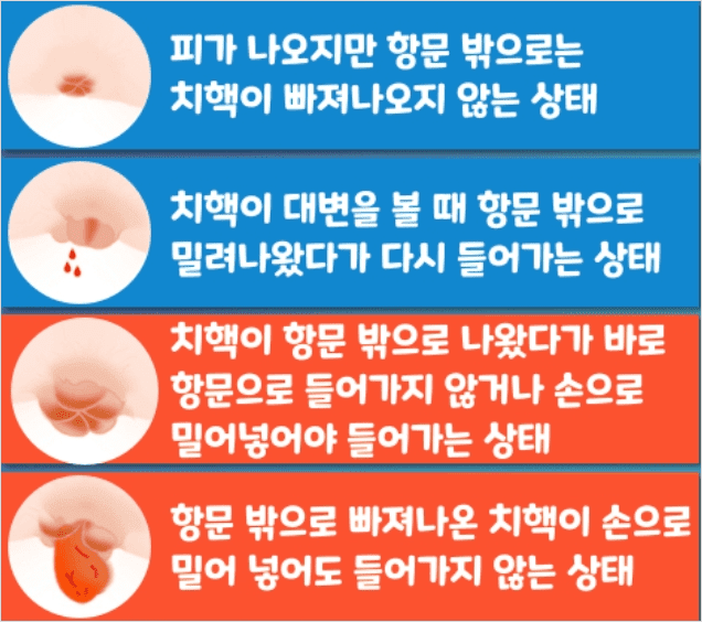 치질 1기부터 4기까지 진행 단계별 치핵 상태 비교