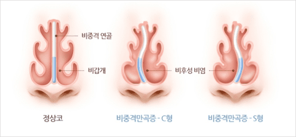 코 중앙 연골이 한쪽으로 휜 비중격만곡증