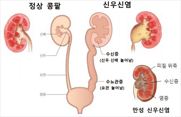 신우신염 등 요로 감염
