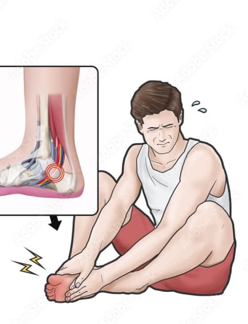 발뒤꿈치 안쪽에 통증이 나타나는 부위