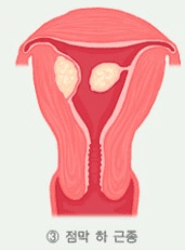 자궁 안쪽으로 자라는 점막하근종