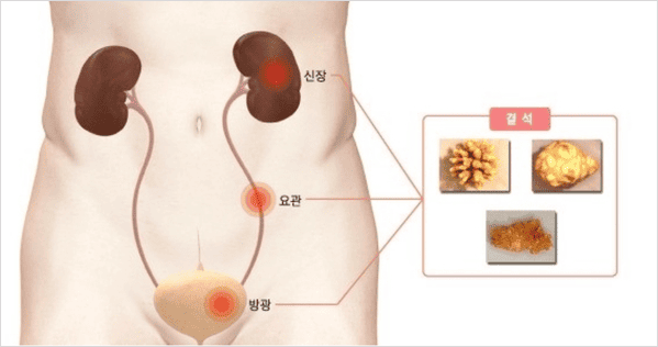 요로를 막아 극심한 통증을 일으키는 결석