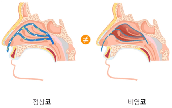정상 코와 비염으로 점막이 부은 코 비교