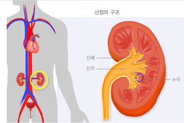 콩팥에 세균 감염이 생기는 신우신염