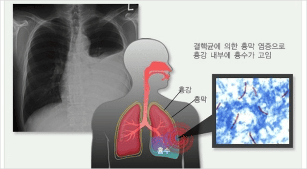 숨 쉴 때 아픈 흉막염