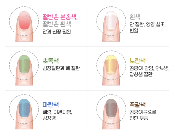 손톱 상태로 살펴보는 건강 이상 신호